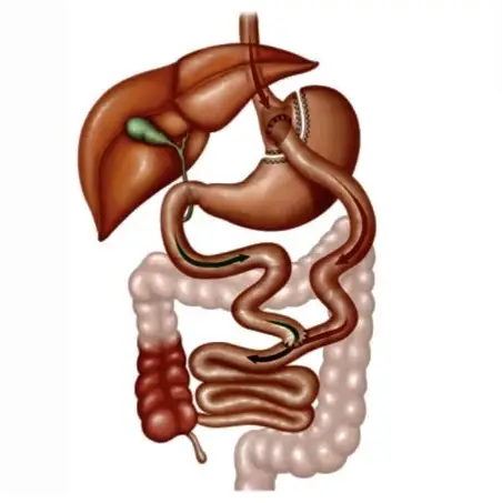 cirurgia bariátrica
obesidade
bypass
bypass gástrico
bariátrica