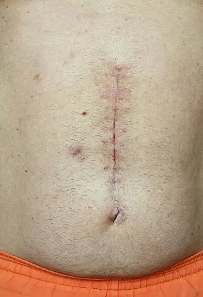 cirurgia bariátrica
obesidade
bariátrica